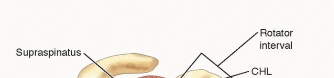 Illustration of degenerative joint disease - Dr. Mohammed Hutaif