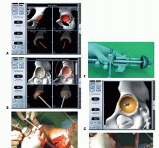 صورة طبية: ترميم مفصل الورك: الحل الأمثل للحفاظ على عظم رأس الفخذ في صنعاء مع الدكتور محمد هطيف