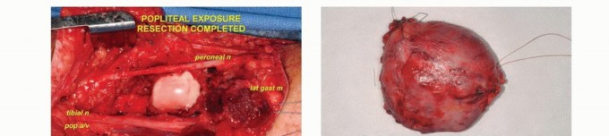 صورة طبية: استئصال الأورام المعقدة في الحفرة المأبضية وحماية الوريد الصافن الكبير: دليل شامل للمرضى مع الأستاذ الدكتور محمد هطيف