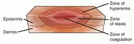 صورة توضيحية لـ جراحات حروق الأطراف العلوية: دليل شامل للمرضى في اليمن والخليج مع الأستاذ الدكتور محمد هطيف