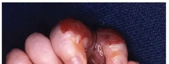 صورة توضيحية لـ أورام وتشوهات اليد الوعائية: دليل شامل للمرضى في اليمن والخليج العربي مع الأستاذ الدكتور محمد هطيف