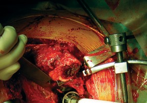 صورة طبية: طول عمر مكون الحُق الأسمنتي في مفصل الورك: مفتاح الاستقرار والديمومة مع الأستاذ الدكتور محمد هطيف في صنعاء