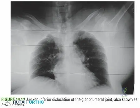 Illustration of inferior glenohumeral dislocation - Dr. Mohammed Hutaif