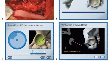 صورة طبية: ترميم مفصل الورك: الحل الأمثل للحفاظ على عظم رأس الفخذ في صنعاء مع الدكتور محمد هطيف