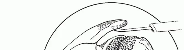 صورة توضيحية لـ تثبيت مفصل الكتف (تجميل الكتف): دليل شامل للمرضى في اليمن والخليج