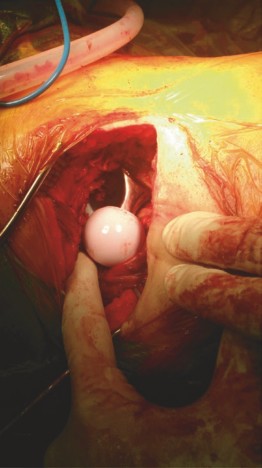 Illustration 9 for Mastering Direct Anterior Approach Hip Arthroplasty Without a Traction Table