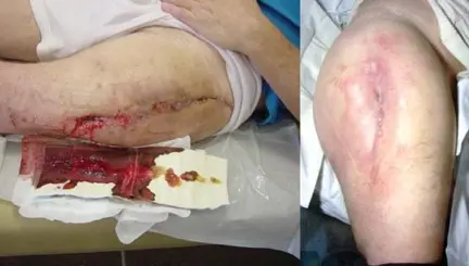 صورة توضيحية لـ علاج عدوى مفصل الورك الصناعي: دليل شامل لمراجعة المفصل على مرحلتين مع الأستاذ الدكتور محمد هطيف في صنعاء