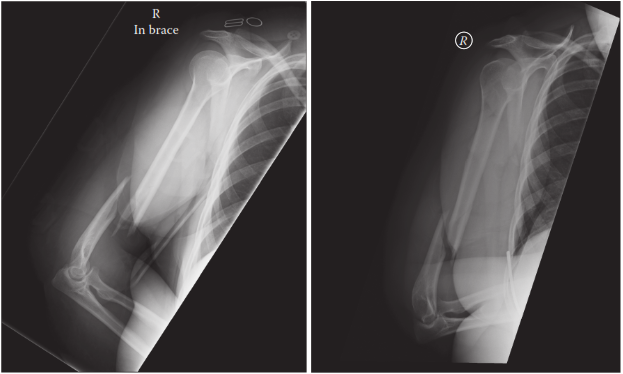 Illustration of holsteinlewis fracture holsteinlewis - Dr. Mohammed Hutaif