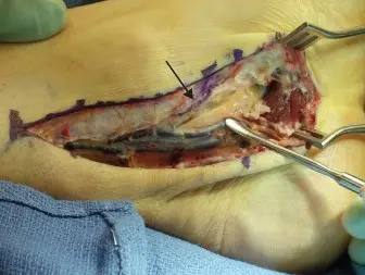 صورة توضيحية لـ التهاب وتر الإبهام الطويل القابض: دليل شامل من الأستاذ الدكتور محمد هطيف