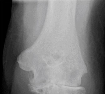 Illustration 78 for Right Shoulder Pain? Avoid This Common X-ray Mistake.