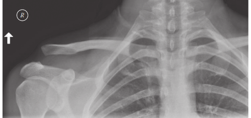 Acromioclavicular Joint Injury: Symptoms, Diagnosis & Treatment