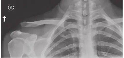 صورة توضيحية لـ إصابات مفصل الترقوة الأخرمي (AC Joint): دليلك الشامل للتشخيص والعلاج في صنعاء مع الأستاذ الدكتور محمد هطيف