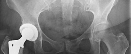 Illustration 6 for Primary Uncemented Total Hip Arthroplasty: A Case Study Title
