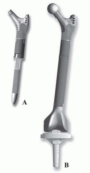 Limb Salvage: New Advances in Proximal Femoral Replacement