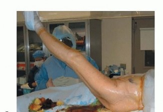 صورة طبية: نصف مفصل الورك: دليلك الشامل لدواعي الاستخدام والأنواع في صنعاء