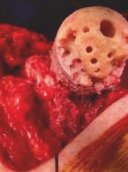 Hemiresurfacing Case Title: Active Young Patient Beats Osteonecrosis