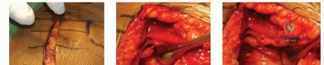 Illustration of displaced proximal humeral - Dr. Mohammed Hutaif