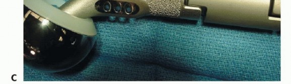 صورة توضيحية لـ استئصال مفصل الورك: دليل شامل للمرضى مع الأستاذ الدكتور محمد هطيف