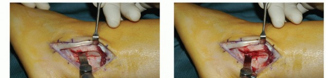 Illustration 19 for Beyond Primary Repair: Solutions for Peroneal Tendon Subluxation