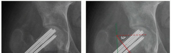 Illustration 25 for Periacetabular Osteotomy: Realigning your hip via the superior pubic ramus