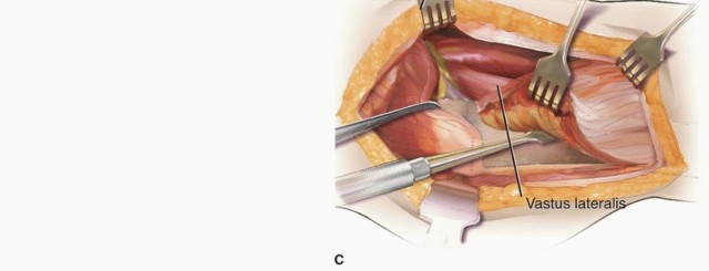 Illustration 31 for Periacetabular Osteotomy: Realigning your hip via the superior pubic ramus