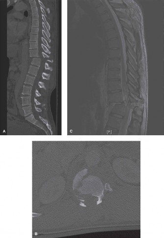Illustration 22 for Spine Cases: Consider the Patient for Accurate Diagnosis