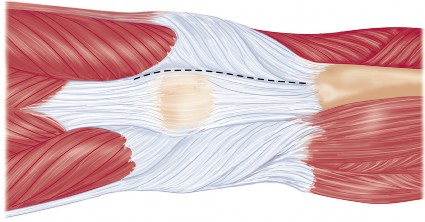 Illustration 6 for Minimize Pain, Maximize Recovery: TKA with Parapatellar