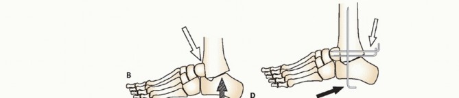 Illustration 10 for Beyond Amputation: Circular Fixation for Infection of the Talus