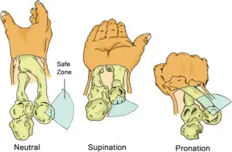 صورة توضيحية لـ كسور رأس الكعبرة: دليل شامل للأسباب، الأعراض، التشخيص والعلاج مع الأستاذ الدكتور محمد هطيف