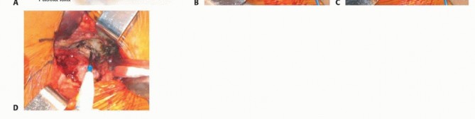 صورة طبية: نصف مفصل الورك: دليلك الشامل لدواعي الاستخدام والأنواع في صنعاء