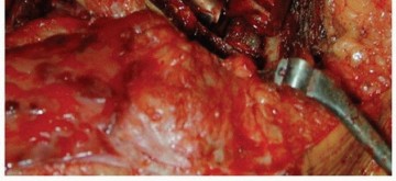 Illustration 20 for Revision THA: Why Extensively Porouscoated Cylindrical Stems Excel