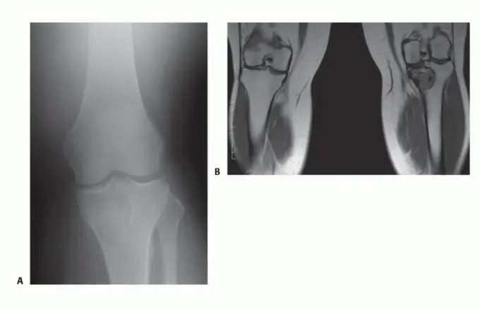 صورة توضيحية لـ تجنب الجراحة الكبرى: علاج أورام العظام بالنيتروجين السائل بتقنية الصب المباشر