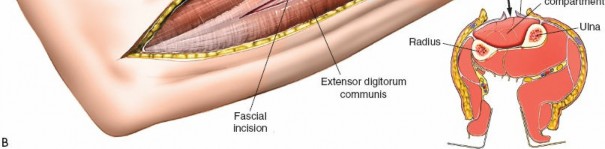 Illustration 103 for Mastering Approaches to the Upper Third of the Radius