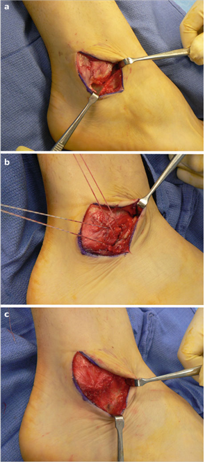 Illustration 26 for First Metatarsal Surgery: Expert Solutions for Foot & Ankle Pain