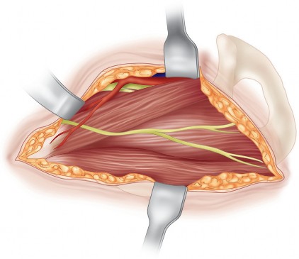 Illustration 20 for Bernese PAO: Unlocking the Procedure with Level V Evidence Insights