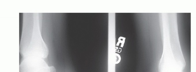 Illustration of treatment of insertional - Dr. Mohammed Hutaif