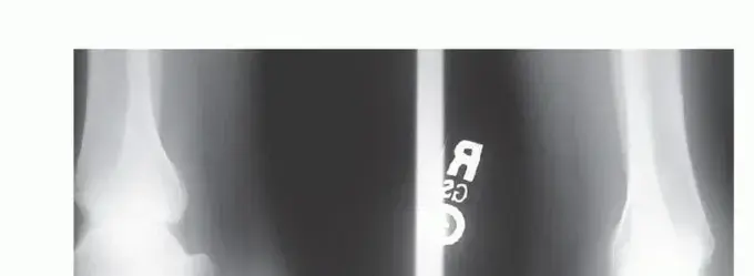 صورة توضيحية لـ التهاب وتر أخيلس الإدخالي: دليلك الشامل للتخلص من آلام الكعب مع الدكتور محمد هطيف