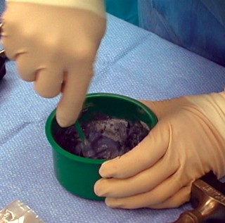 Illustration 31 for Cemented TKA Figure: Your Visual Guide to Surgical Success