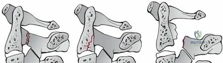 Illustration of spondylolisthesis of c - Dr. Mohammed Hutaif