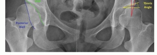 Illustration 4 for Restore Hip Health: Pelvic Osteotomy for Acetabular Dysplasia & CEA of Less