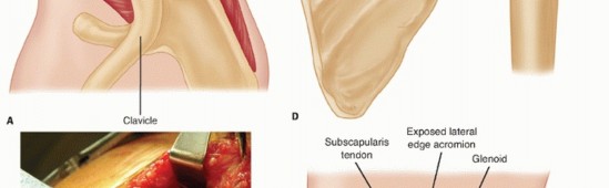 Illustration 11 for Restore Shoulder Function with Latissimus Dorsi Tendon Transfer
