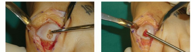 Illustration 19 for Mastering Extensive Plantar Release for Hallux Rigidus