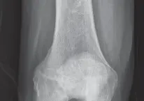 صورة توضيحية لـ استبدال مفصل الركبة بالحد الأدنى من التدخل الجراحي: ألم أقل وتعافٍ أسرع مع النهج شبه الرضفي الإنسي