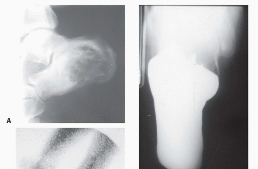 صورة توضيحية لـ أورام القدم: دليلك الشامل للعلاج، البتر، والاستئصال مع الأستاذ الدكتور محمد هطيف في صنعاء