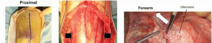 Illustration 27 for Surgical Approaches to Shoulder & Elbow: Pearls and Pitfalls