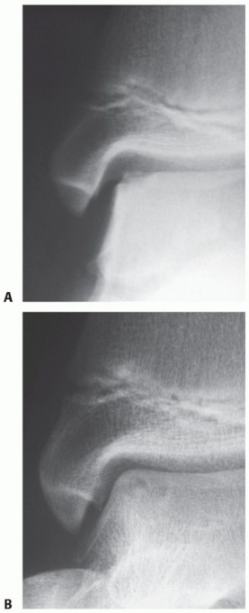 Illustration 3 for Restore Damaged Cartilage with Autologous Chondrocyte Transplantation