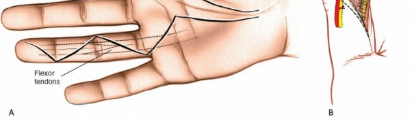 Illustration 144 for Essential Surgical Approaches: Uncover Every Aspect of the Wrist