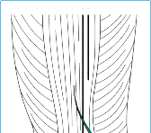 Illustration of distal femoral osteotomy - Dr. Mohammed Hutaif