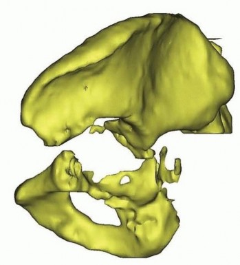 Illustration 4 for Pelvic Discontinuity: Understanding Superior and Inferior Separation