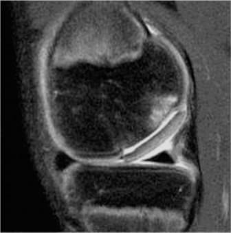Illustration 4 for Pediatric OCD: When to Consider Drilling for the Femoral